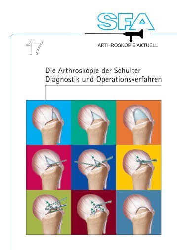 Die Arthroskopie der Schulter Diagnostik und Operationsverfahren