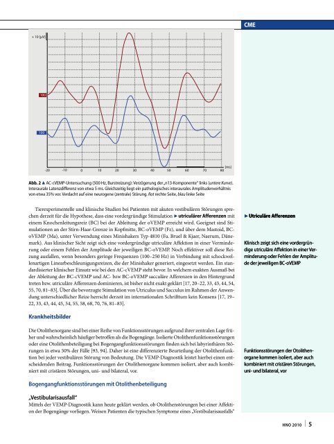 Die Ableitung zervikaler und okulärer vestibulär evozierter ...