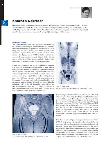 Knochen-Nekrosen - Rheuma Schweiz