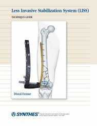 Less Invasive Stabilization System (LISS) Technique Guide - DrStorm