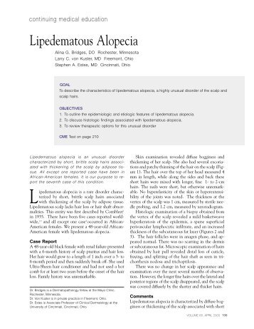 Lipedematous Alopecia - Skin & Allergy News