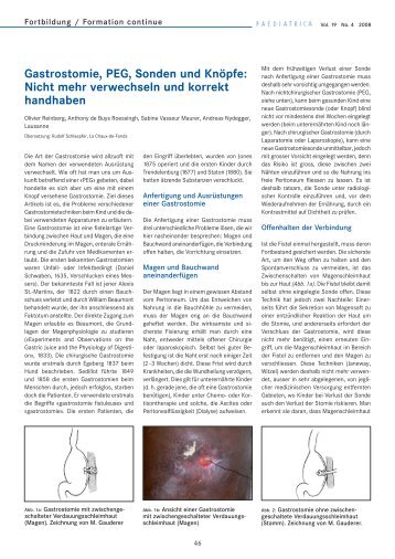 Gastrostomie, PEG, Sonden und Knöpfe: Nicht mehr verwechseln ...