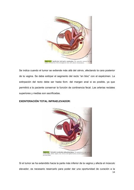 Exenteración pélvica en Ginecología Oncológica: 12 ... - Recercat