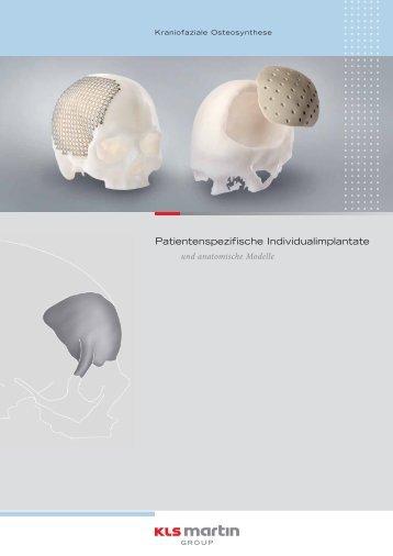 Patientenspezifische Individualimplantate - KLS Martin