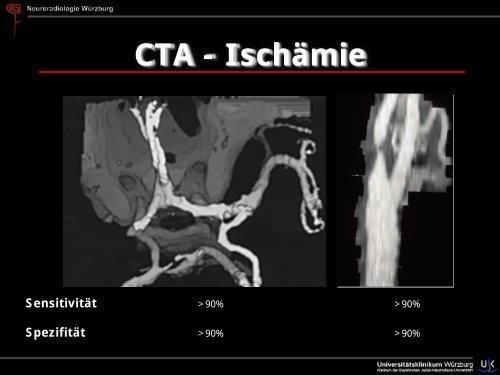 Schlaganfall - Abteilung für Neuroradiologie