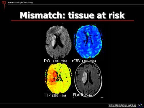 Schlaganfall - Abteilung für Neuroradiologie