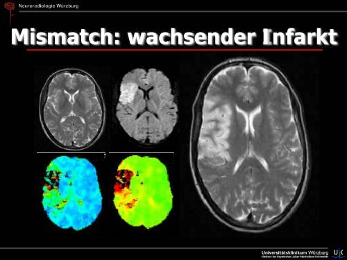 Schlaganfall - Abteilung für Neuroradiologie