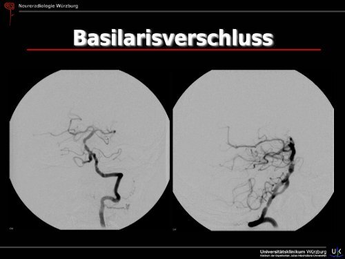 Schlaganfall - Abteilung für Neuroradiologie