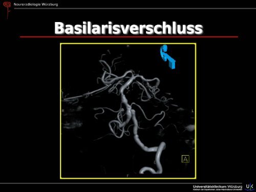 Schlaganfall - Abteilung für Neuroradiologie