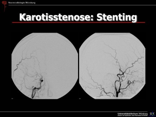 Schlaganfall - Abteilung für Neuroradiologie