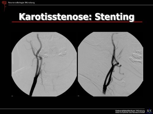 Schlaganfall - Abteilung für Neuroradiologie