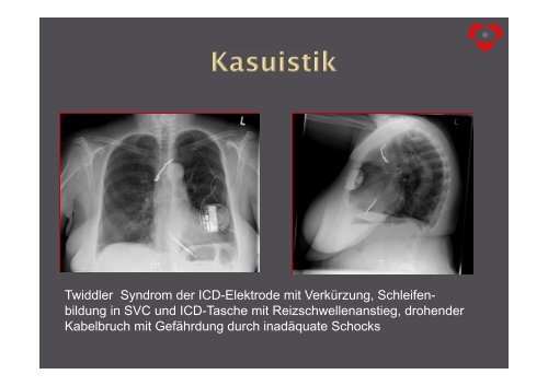 Sonden-Entfernung in der Device-Therapie - Herzzentrum Saar