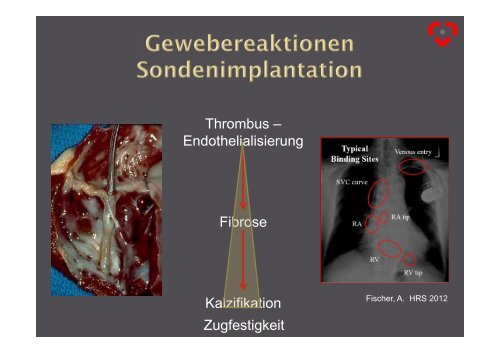 Sonden-Entfernung in der Device-Therapie - Herzzentrum Saar