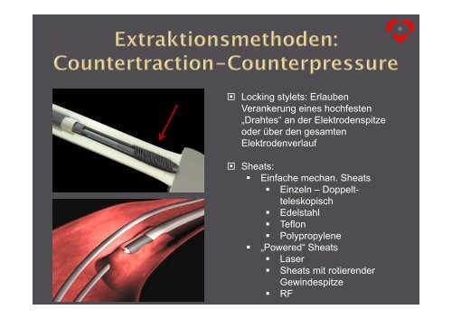 Sonden-Entfernung in der Device-Therapie - Herzzentrum Saar