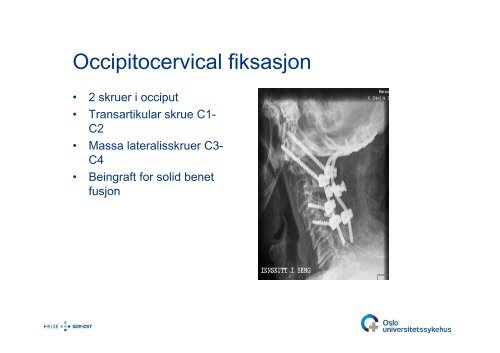 Bjarne Lied: C0-C2-frakturer - Oslo universitetssykehus