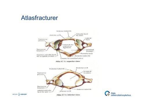 Bjarne Lied: C0-C2-frakturer - Oslo universitetssykehus