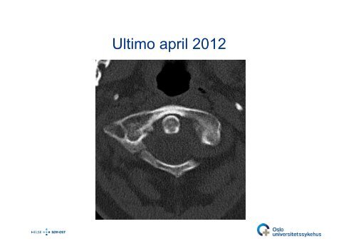 Bjarne Lied: C0-C2-frakturer - Oslo universitetssykehus