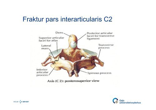 Bjarne Lied: C0-C2-frakturer - Oslo universitetssykehus