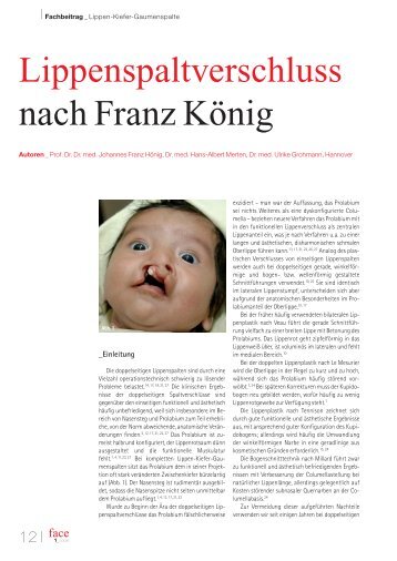 Lippenspaltverschluss nach Franz König