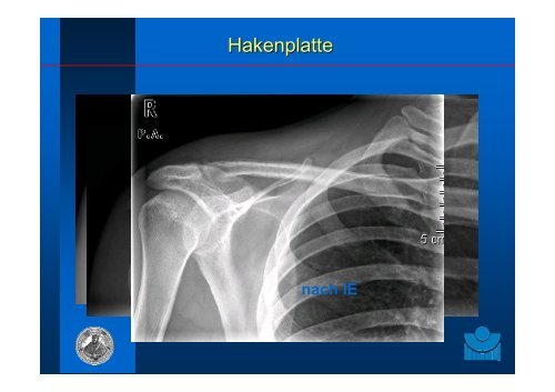 Frakturen obere Extremität PD Dr. Thomas Mückley - Klinik für Unfall ...