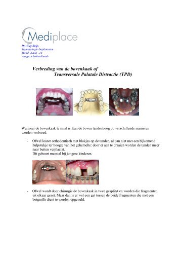 verbreding van de bovenkaak of TPD.pdf