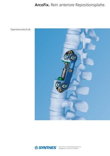 ArcoFix. Rein anteriore Repositionsplatte. - Synthes