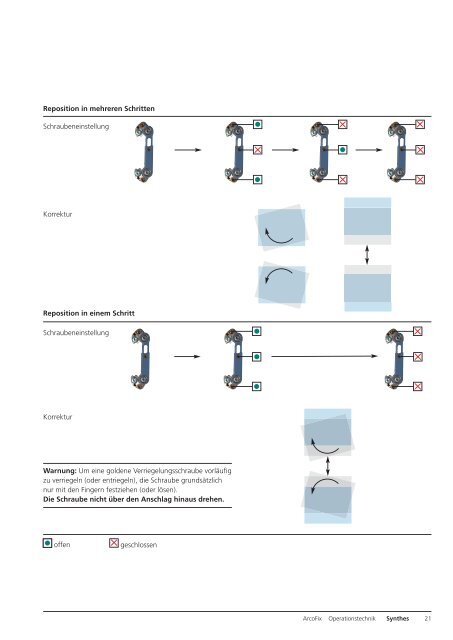 ArcoFix. Rein anteriore Repositionsplatte. - Synthes