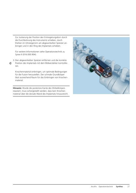 ArcoFix. Rein anteriore Repositionsplatte. - Synthes