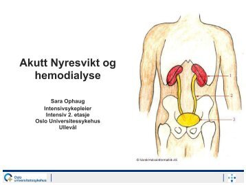Akutt Nyresvikt og hemodialyse - Intensivt i Oslo