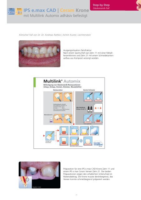 IPS e.max Clinical Guide - Ivoclar Vivadent