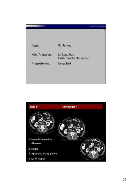 Appendizitis epiploica