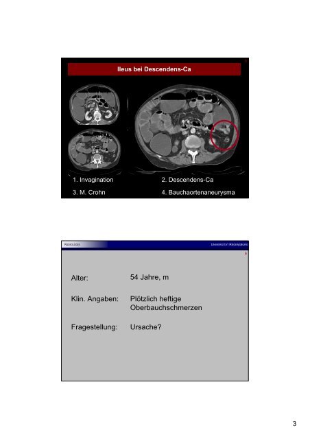 Appendizitis epiploica