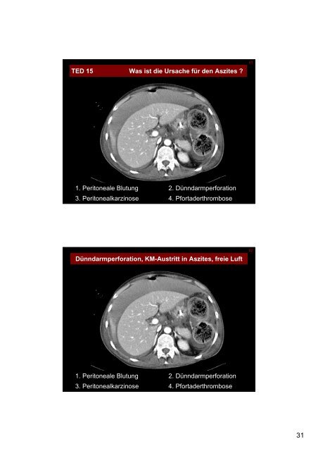 Appendizitis epiploica