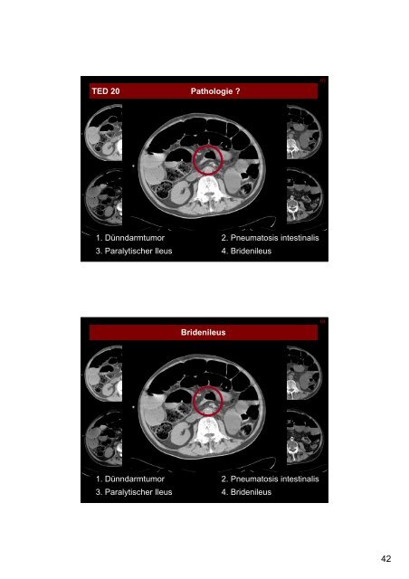 Appendizitis epiploica