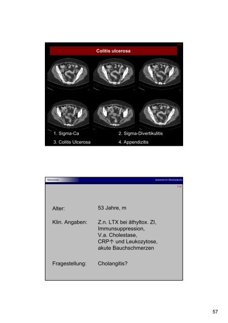 Appendizitis epiploica