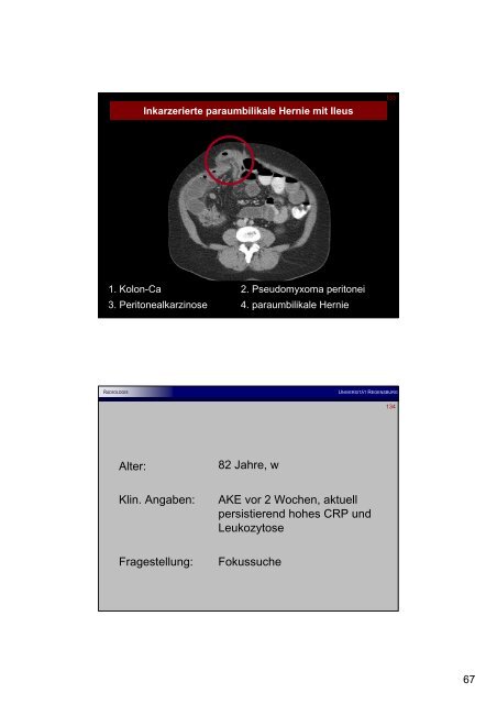 Appendizitis epiploica