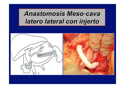 oportunidad del tratamiento quirurgico de la hipertension portal