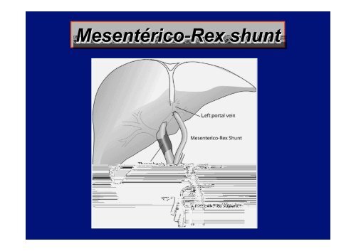 oportunidad del tratamiento quirurgico de la hipertension portal