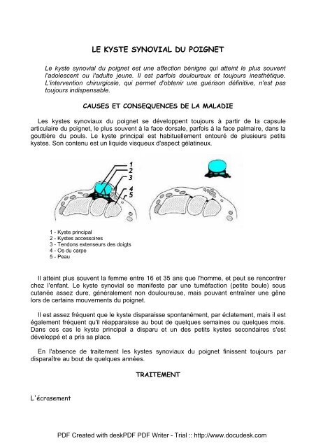 Le kyste synovial du poignet - Groupe Keraudren Grand-Large