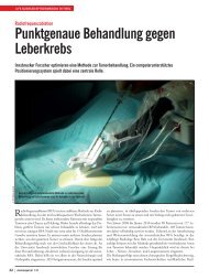 Punktgenaue Behandlung gegen Leberkrebs - Mikroinvasive Therapie