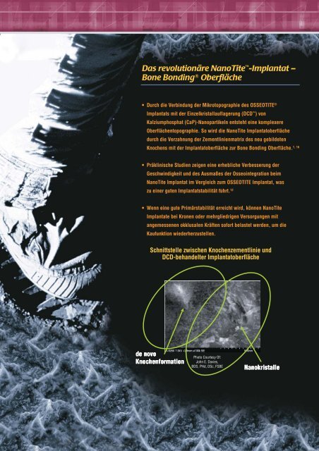 Das NanoTite ™ -Implantat mit Bone Bonding ® Effekt - BIOMET 3i