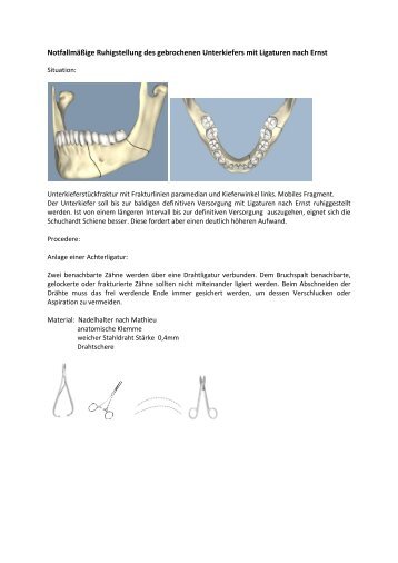 Notfallmäßige Ruhigstellung des gebrochenen Unterkiefers mit ...