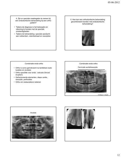 Relaties tussen endodontologie en orthodontie ... - shemesh.nl