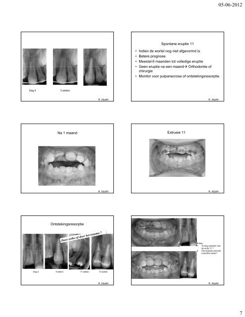 Relaties tussen endodontologie en orthodontie ... - shemesh.nl