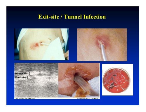 Peritonitis Management in Children on PD Peritonitis Management ...