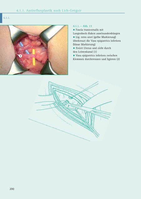 4.1.1. Antirefluxplastik nach Lich-Grégoir - Minerva KG Gude