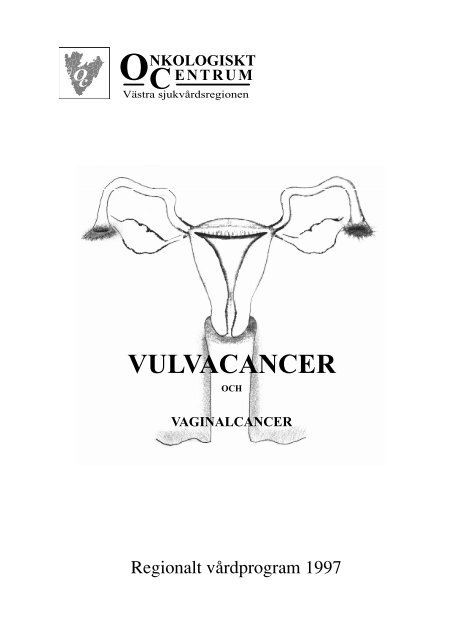 Vulvacancer och vaginalcancer