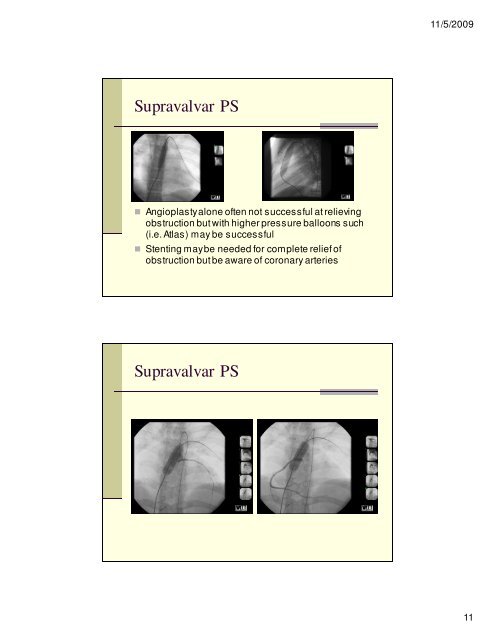 Angiography and Intervention in TGV