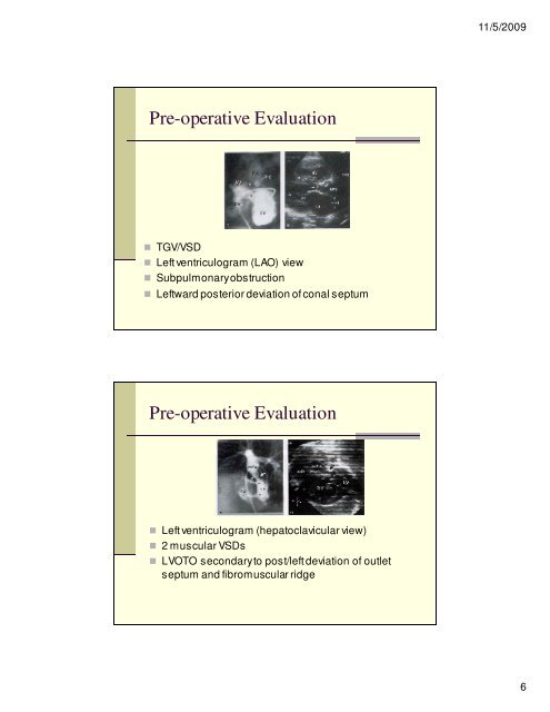 Angiography and Intervention in TGV