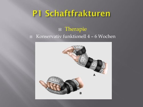 Frakturen des Handskelettes (PDF, 5.6MB)